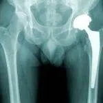 استئومالیت حاد و آرتریت سپتیک در کودکان(اصل مقاله ترجمه و پروپزال)
